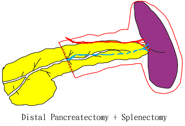 distal pancreatectomy